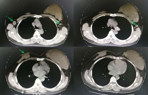 bc青年团|岳文杰:乳腺癌合并对侧交界性叶状肿瘤病例