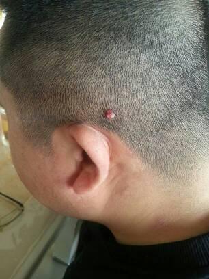 脑后刚起来一个小肉瘤怎么回事