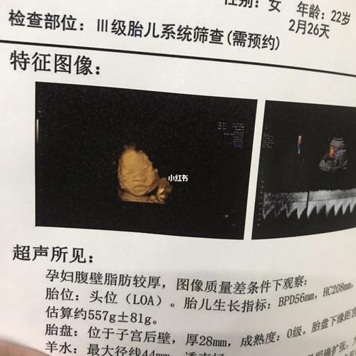 彩超四维顺利通过啦_四维彩超_女宝宝_孕妈_四维彩超