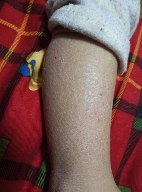 宝宝快2岁了皮肤总是干裂痒怎么回事怎么办