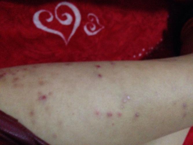 有知道是什么疙瘩的吗?去医院看有说是丘疹有说是湿疹