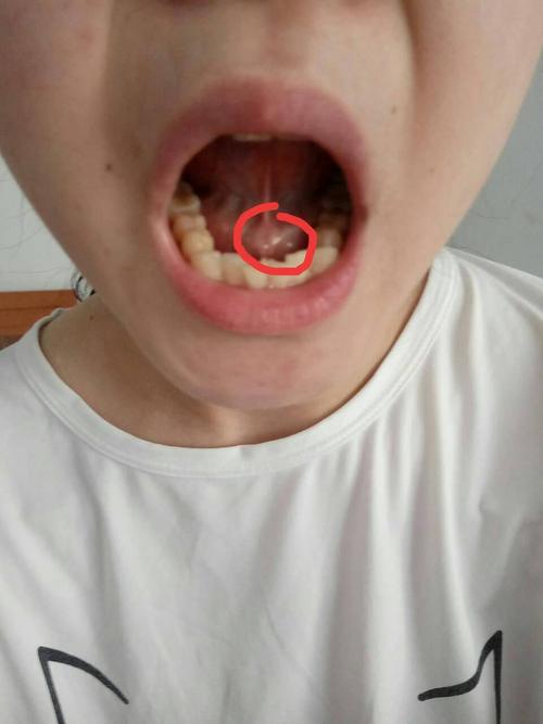 舌头下面长个东西是什么?