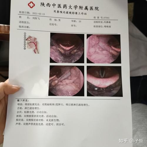 感觉快被慢性咽炎折磨死了010101