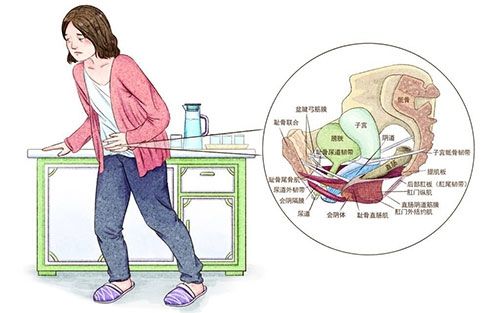 女性尿失禁的原因有哪些 尿失禁的治疗方法_养生人群_鸿运国际游戏网