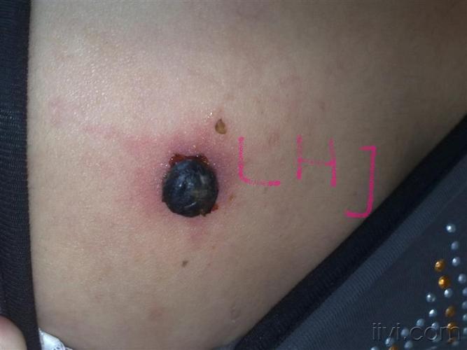 看图说话-背部化脓性肉芽肿