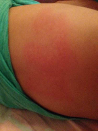 宝宝身上起疙瘩,怎么回事?