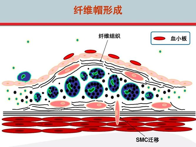 无忧文档 所有分类 医药卫生 高血压抗动脉粥样硬化治疗ppt  纤维帽