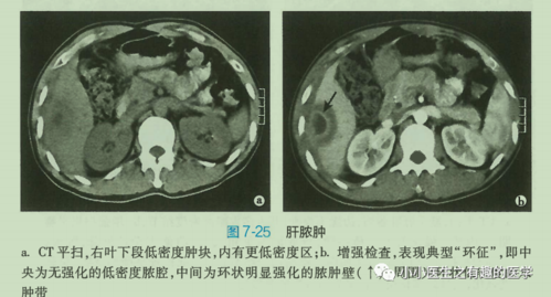 假如ct或者磁共振报告肝脏脓肿,肝囊肿,肝癌,我就用超声去找,多看几