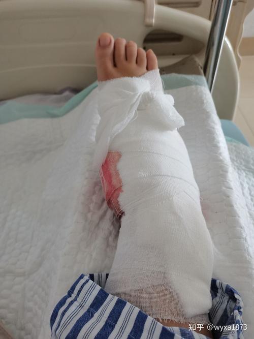 脚踝骨折及恢复过程记录