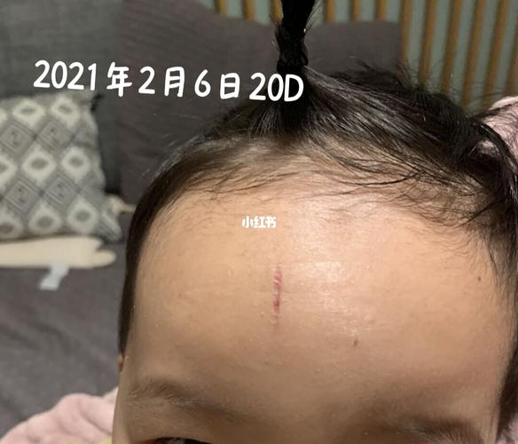 14天,20天医用胶粘合伤口情况_泡温泉_母婴_育儿经验