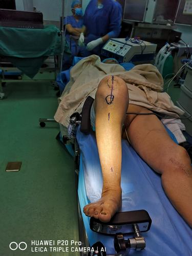 我的人工膝关节置换情结!