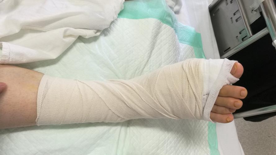 图一 弹力绷带加压包扎,注意良好衬垫,弹力绷带远端勿超过跖趾关节图