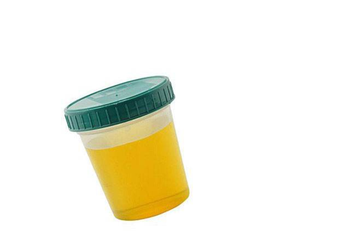 如果尿液呈现像洗肉水一样的鲜红色,两年了,尿液中含有红细胞,可能