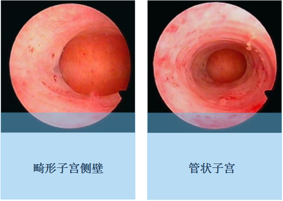 宫腔镜对话异型子宫