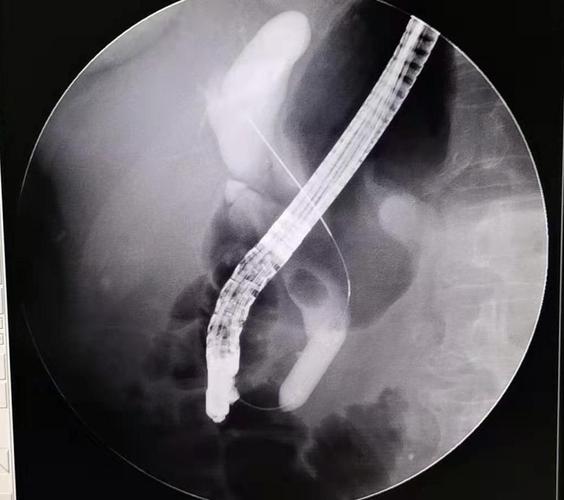 术(eus-fna),ercp术,经十二指肠镜取活检术,网篮取石术,胆道金属支架