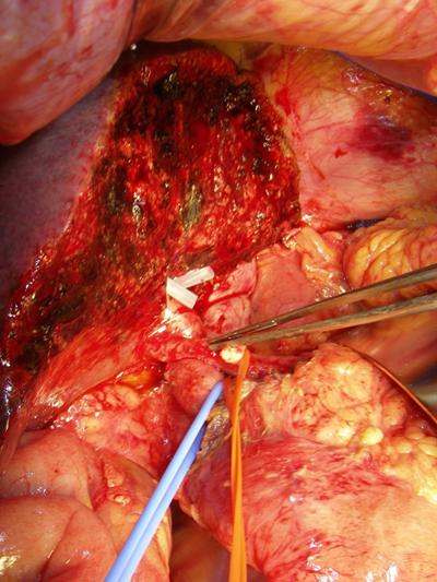 83岁老伯患胆管癌,医生勇攀"珠峰"实施手术_家庭医生在线肿瘤频道