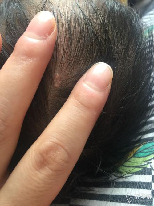 宝宝头上有块肉色疙瘩