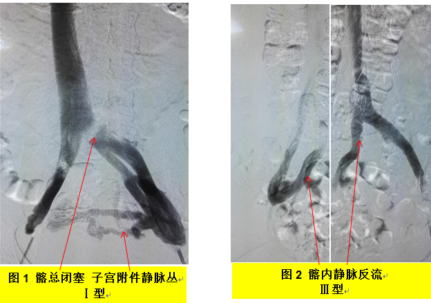 下肢顺行静脉造影在髂静脉受压疾病的筛查率观察