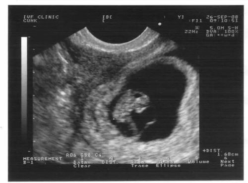 怀孕多久b超能看出孕囊?孕囊小是什么原因?