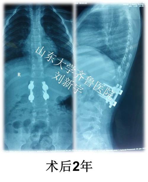 典型病例3:先天性脊柱侧凸