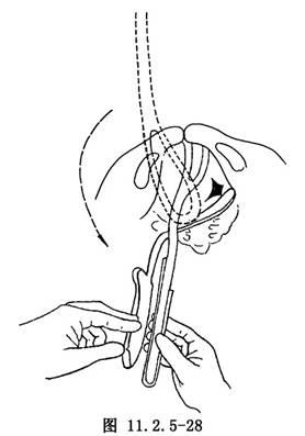 产钳术_英文_拼音_什么是产钳术_医学百科