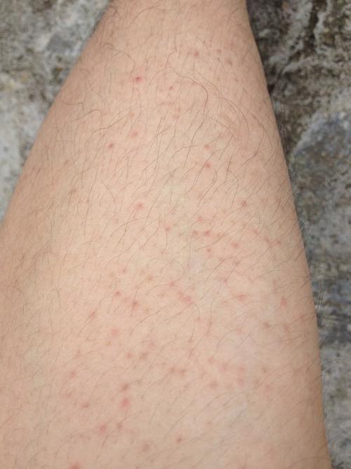 大腿上有很多小红点
