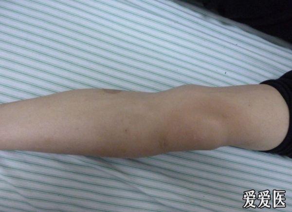 看看这是骨肉瘤还是骨髓炎