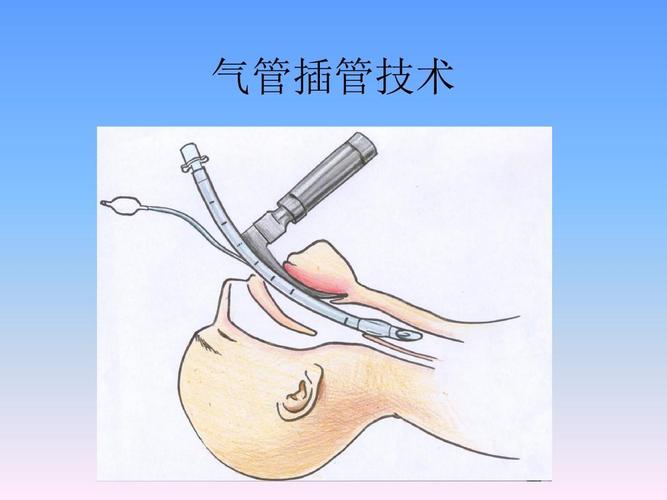 气管插管技术