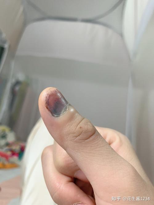 快一星期了,指甲根部已经这样了?发白. 医院开的消炎药也没啥用.