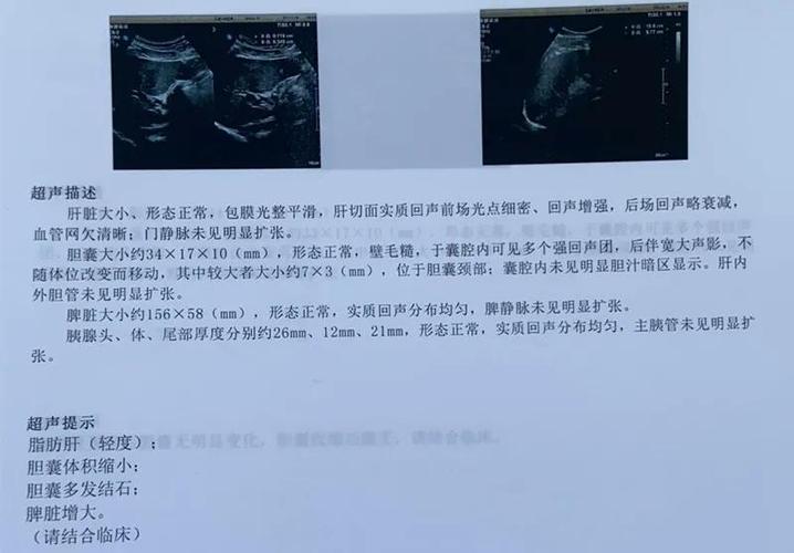 原创4年拖延让胆结石变成胆囊十二指肠瘘