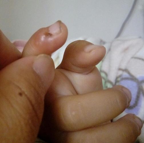 宝宝食指总是肿着,还有水泡,有时破了流脓水,大概有一