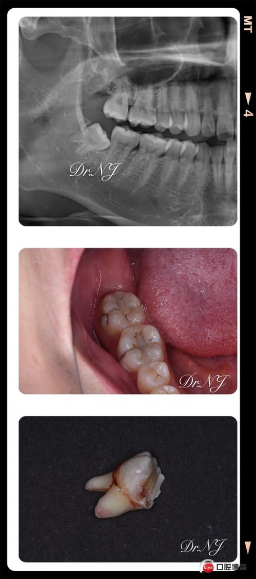 埋伏近中阻生智齿拔除一例.