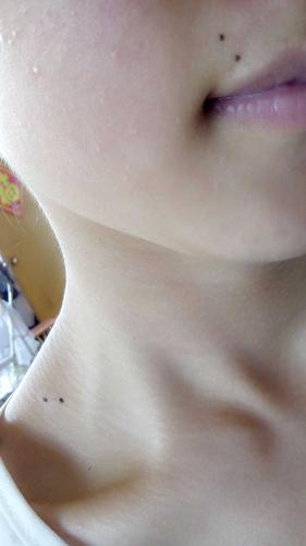 右侧嘴角和锁骨上侧都有两个痣 出生就有 刚开始不明显 随年龄长 这两
