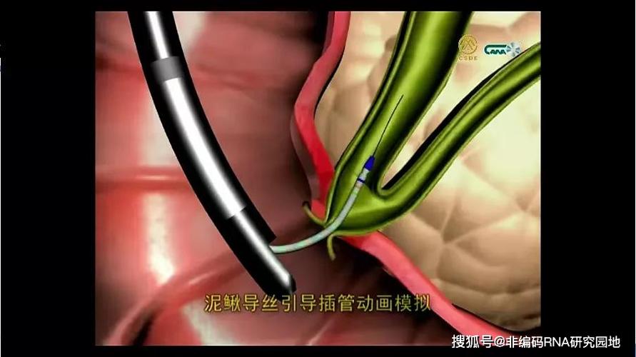 技术 消化道支架植入技术 消化内镜隧道技术 胰管病变ercp诊治技术 小