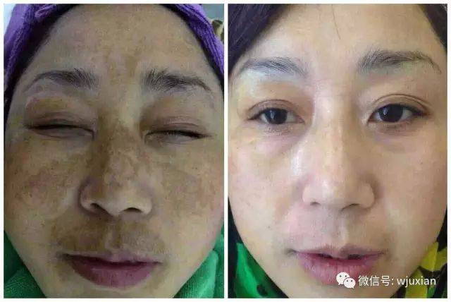 说实话,这五官长的挺好,特别是眼睛,怎么可以因为斑的存在而拉低颜值