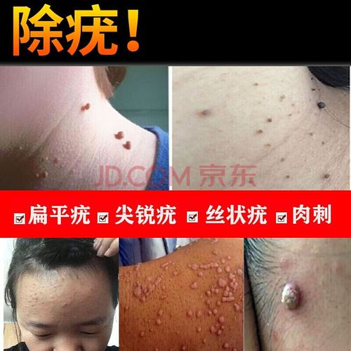 兰润泰康尤克净克忧液丝状疣面部私处脖子上的小肉粒刺猴疣瘊净膏 1瓶