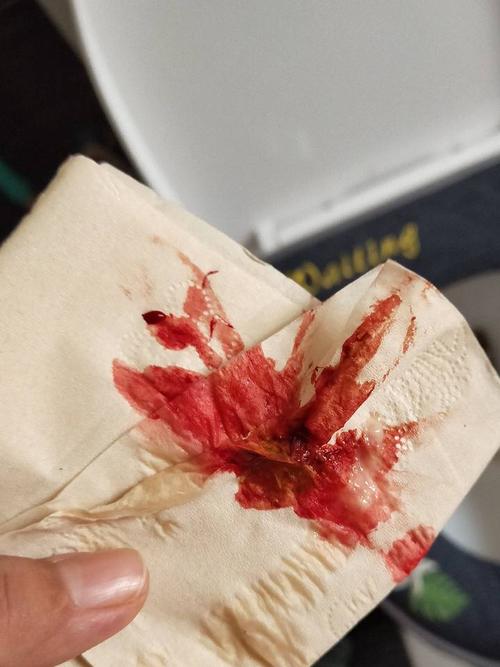 剖腹产后内痔了 便秘偶尔有沾血 不疼 擦屁股的时候纸