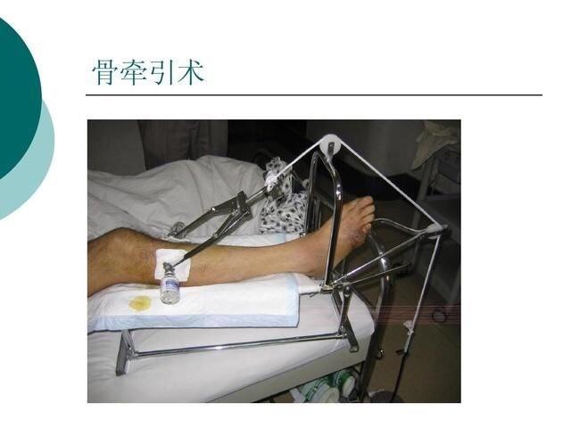 永年中医院外一科,股骨多处骨折病例分享