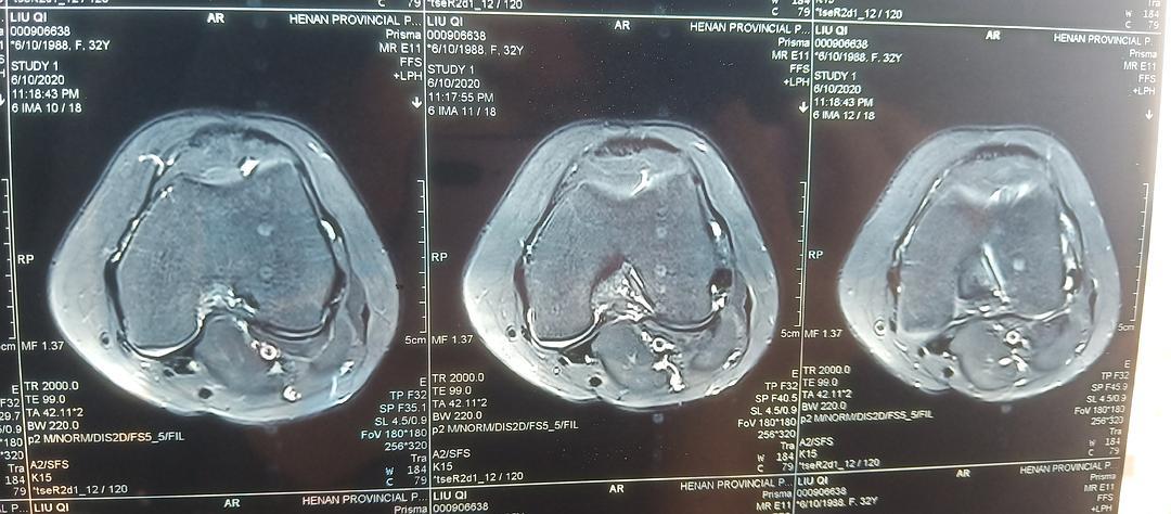 膝关节核磁共振读片