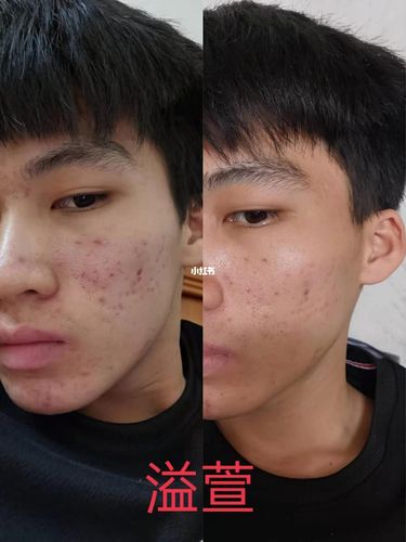为什么我总在发溢萱祛痘产品用过之后反馈的前后对比图,因为用过的人