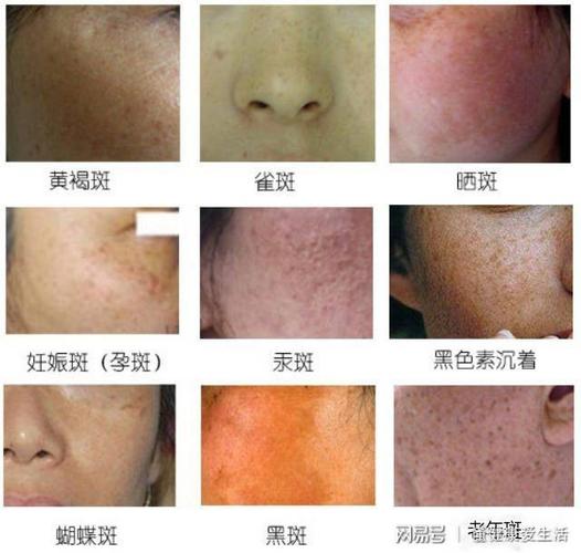 色斑|雀斑|色素|紫外线