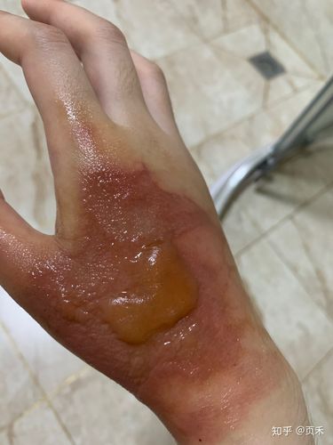 手被开水烫伤恢复记录多图慎入