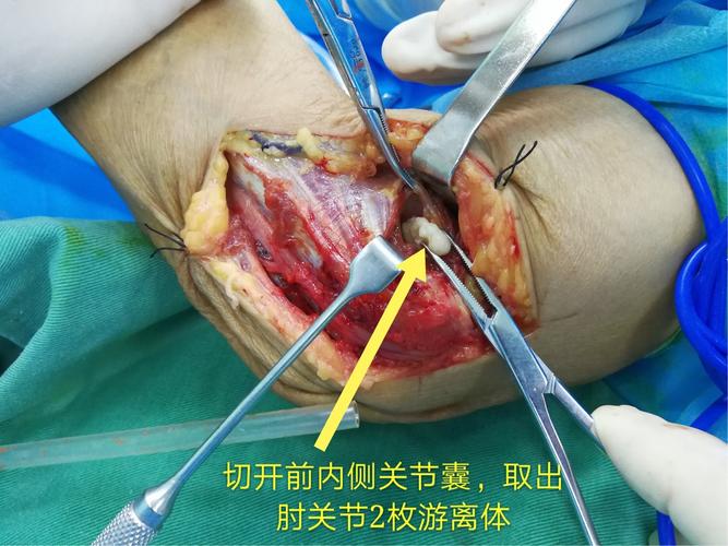 肘管内巨大腱鞘囊肿致尺神经卡压一例