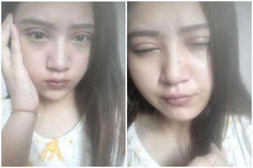 全切开双眼皮后 变身混血女孩儿