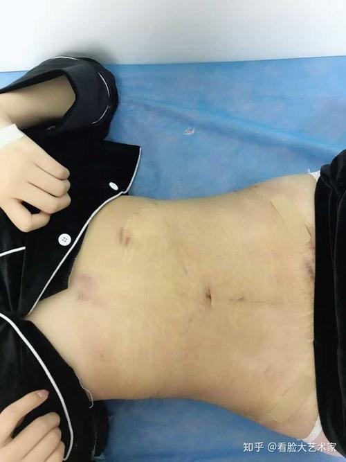 腰腹吸脂,朋友都说我疯了