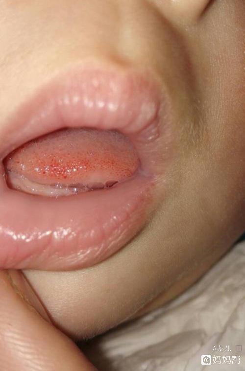 宝宝8个月.舌尖上有红点是怎么回事啊
