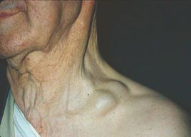 virchow淋巴结一般指魏尔啸淋巴结