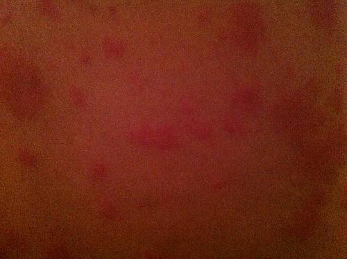 为什么脸颊两侧长了很多红色的小疙瘩 脸颊疙瘩皮肤科