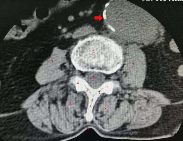 2为椎体;3为椎板;4为关节突;5为棘突;6为硬膜囊;7为腰大肌;8为竖脊肌