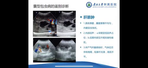 肝包虫病的超声分型与鉴别诊断